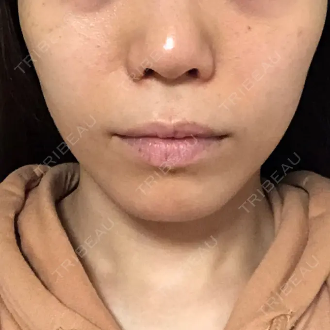 人中短縮 / その他（口元） eクリニック 金沢本院 BEFORE メイン用