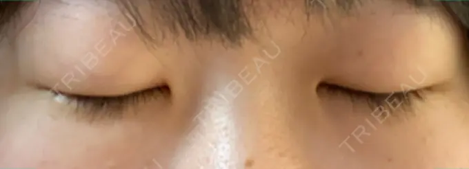 二重埋没 湘南メディカル記念病院（両国） BEFORE メイン用