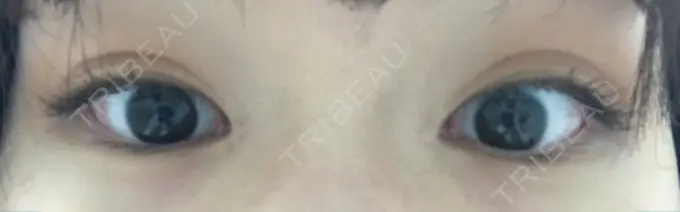 ヒアルロン酸注入（涙袋） フィラークリニック 横浜院 BEFORE メイン用