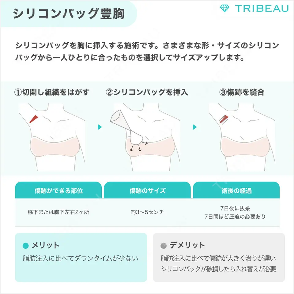 豊胸（シリコン＋脂肪併用）の解説画像4