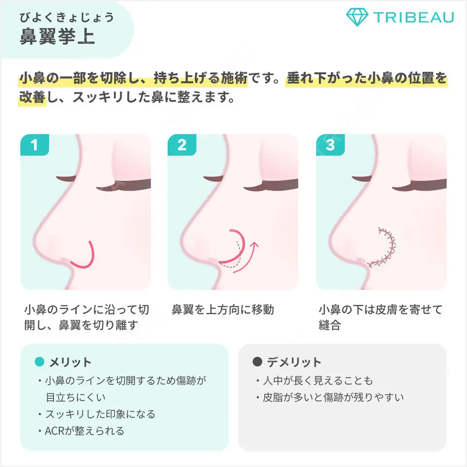 小鼻縮小（切開）の解説画像5