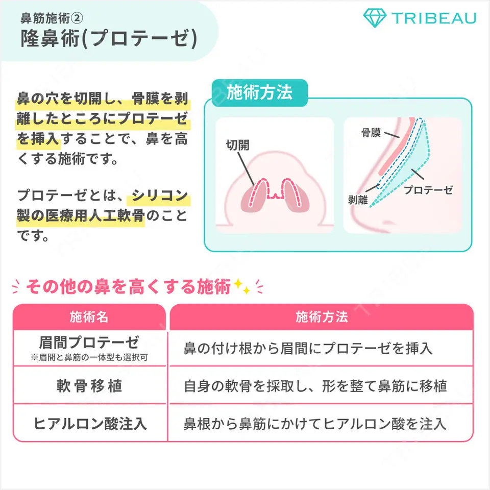 ワシ鼻修正・ハンプ切除の解説画像5