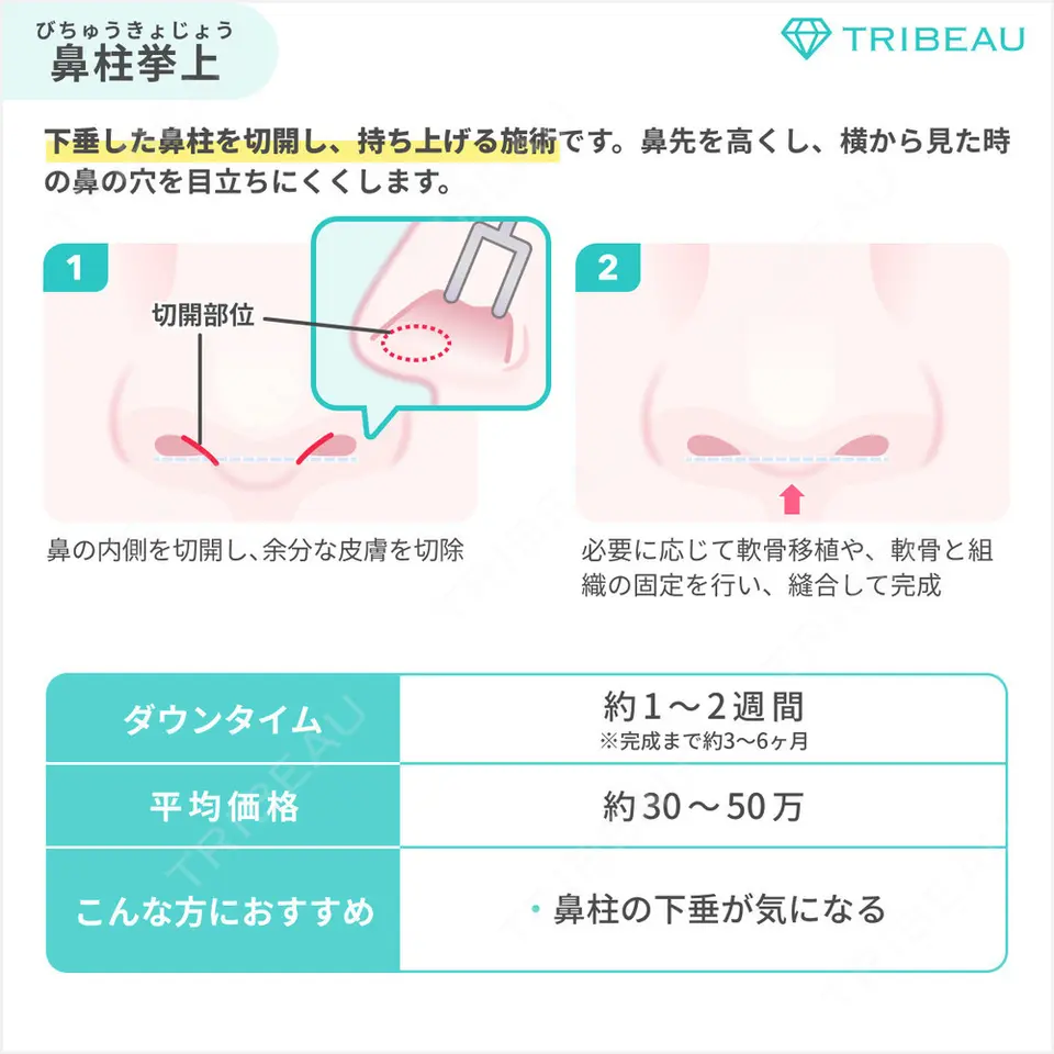 鼻尖縮小の解説画像5