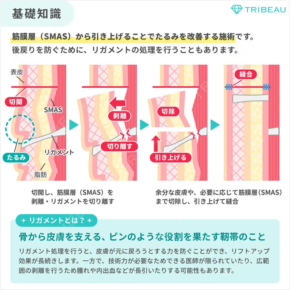 ネックリフトの解説画像2