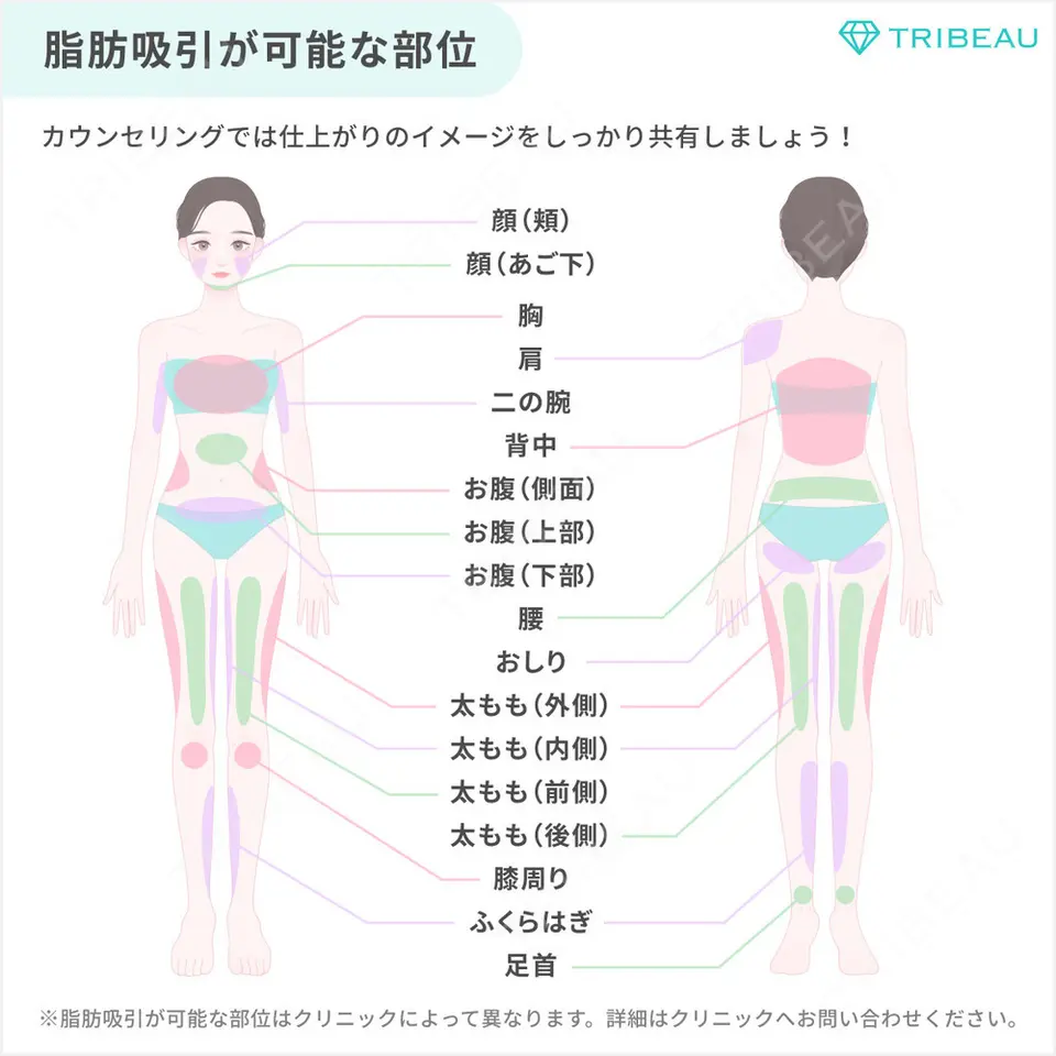 脂肪吸引（腰）の解説画像2
