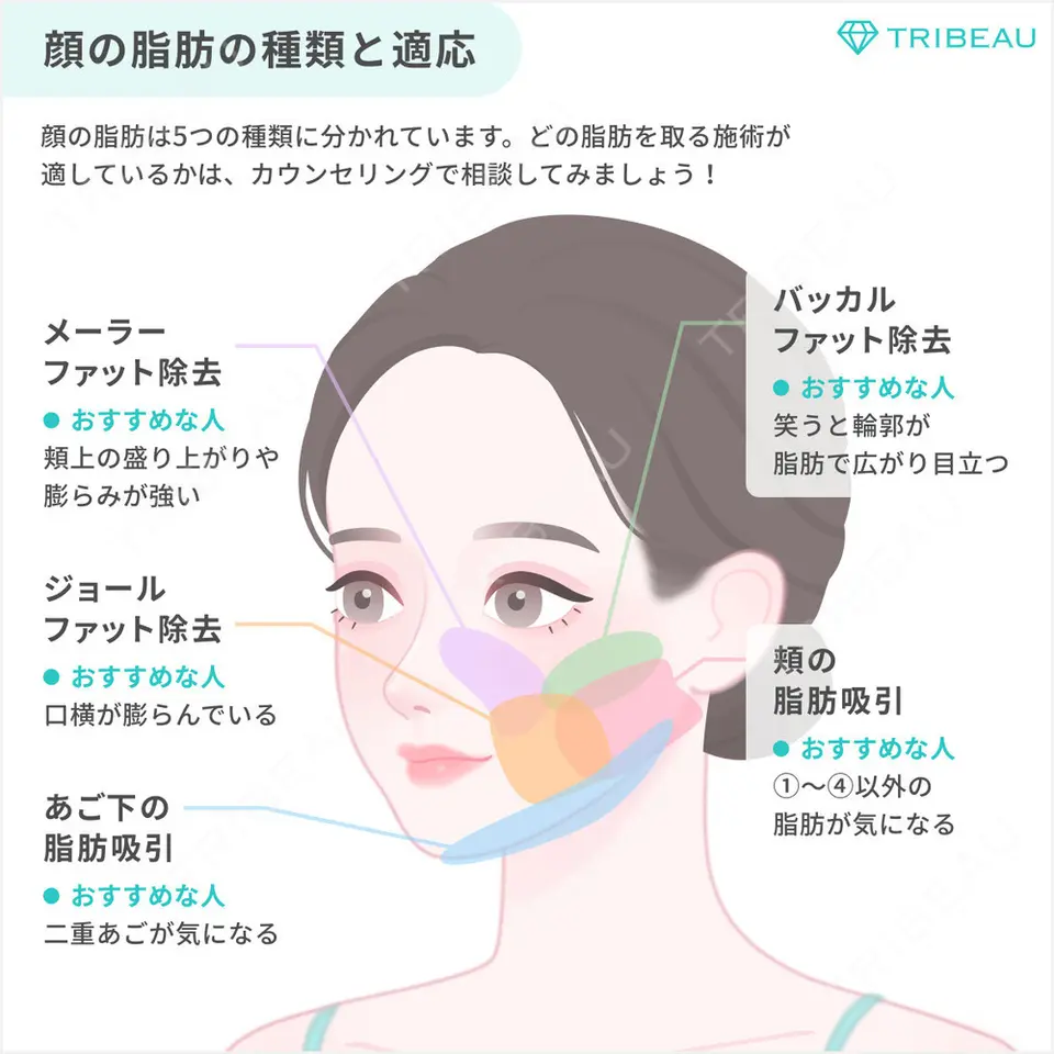 脂肪吸引（腰）の解説画像3