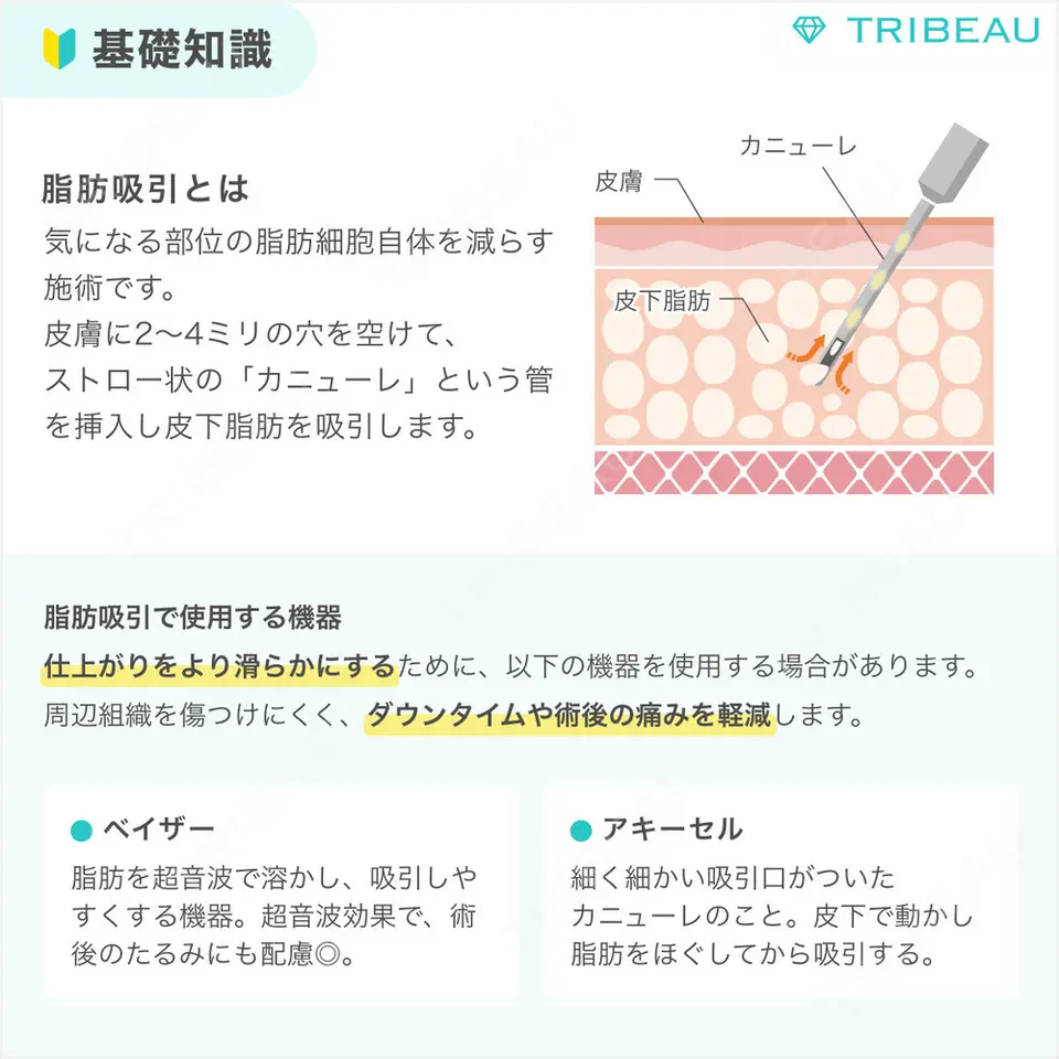 脂肪吸引（二の腕）の解説画像1