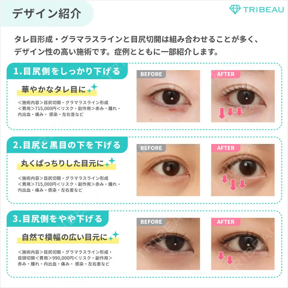 タレ目形成・グラマラスライン（切開）の美容外科・美容皮膚科クリニック一覧【489件】 | トリビュー[TRIBEAU]